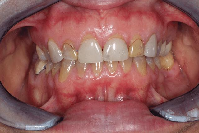 Upper Veneers