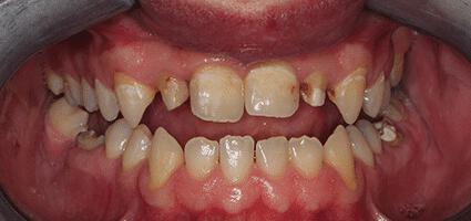 Crowns Full Upper