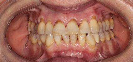 Crowns Full Upper