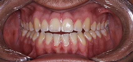 Anthony – Veneers