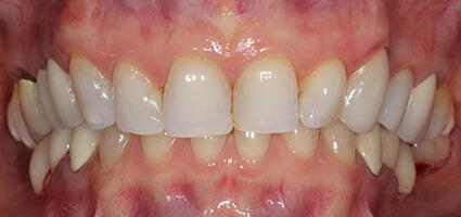 Facial Rejuvenation