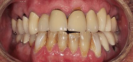 Crowns Full Upper