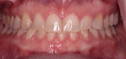 Facial Rejuvenation