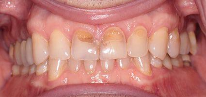 Porcelain Veneers