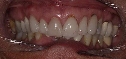 Smile Makeover