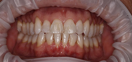 Porcelain Veneers