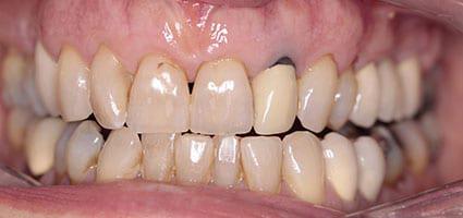 Porcelain Veneers