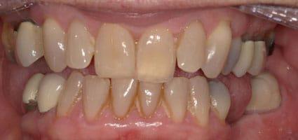 Porcelain Veneers