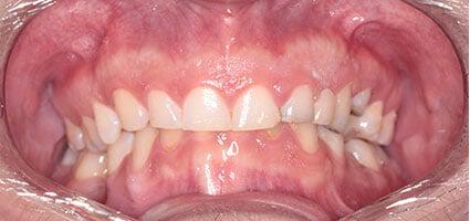 Porcelain Veneers