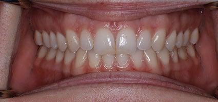 Laser Gum Lift and Porcelain Veneers