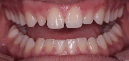 Porcelain Veneers