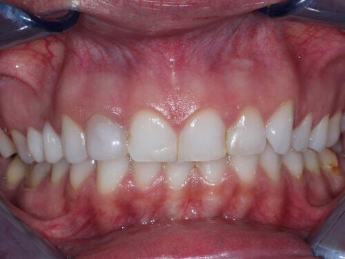 Porcelain Veneers