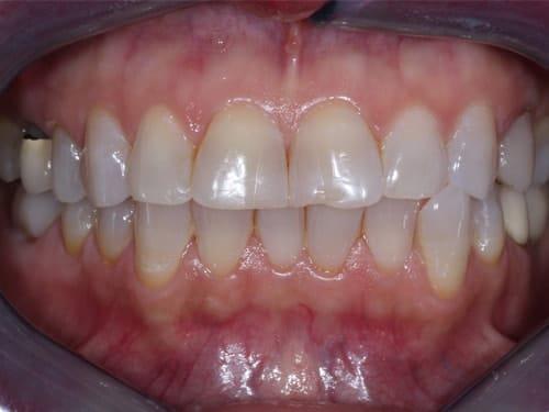 Porcelain Veneers