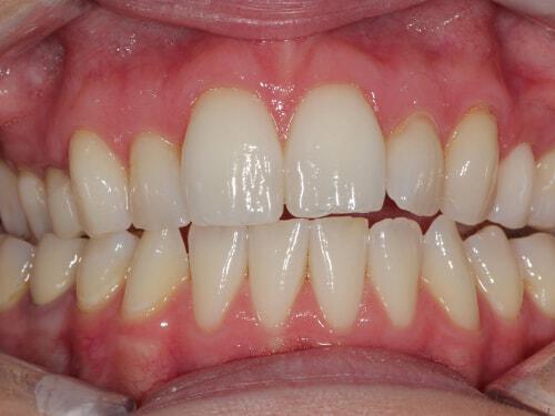 Porcelain Veneers