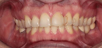 Laminate Veneers