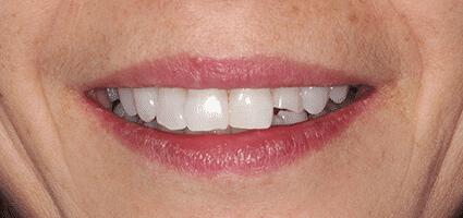 Laminate Veneers