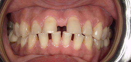 Smile Makeover/ Full Mouth Rehab