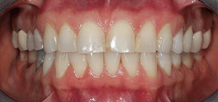 Full Mouth Reconstruction
