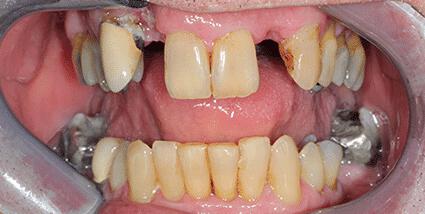 Full Mouth Reconstruction