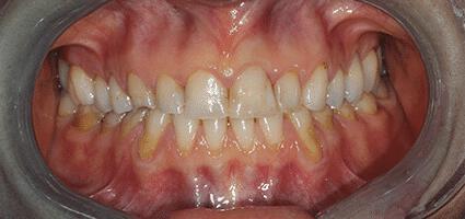 Full Mouth Reconstruction