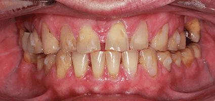 Full Mouth Reconstruction