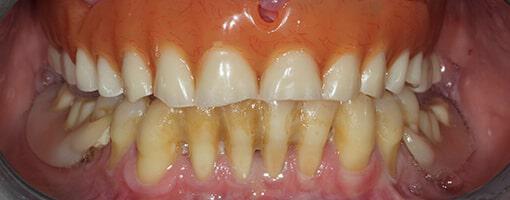 Full Mouth Reconstruction