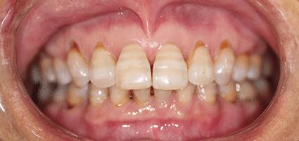 Full Mouth Restoration