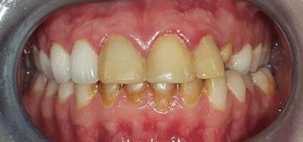 Upper Crowns