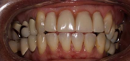Full Mouth Reconstruction