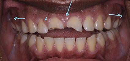 Porcelain Veneers and Invisalign