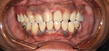 Full Mouth Reconstruction