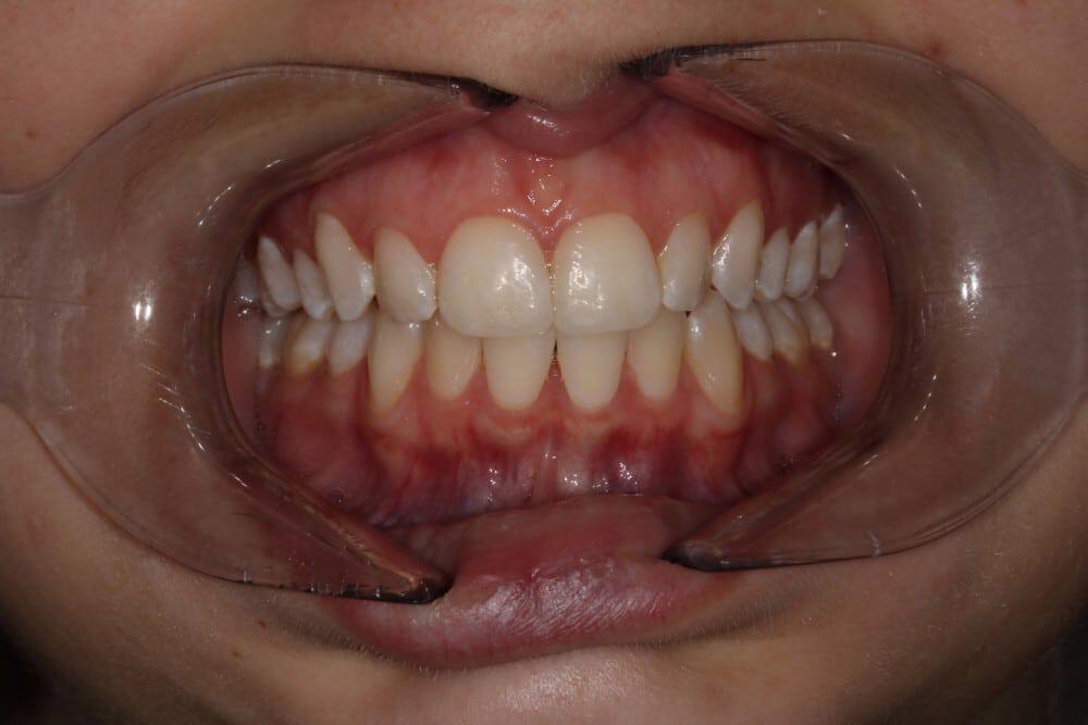 Full Mouth Reconstruction