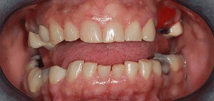 Crowns Full Upper