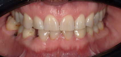 Smile Makeover