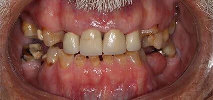 Full Mouth Reconstruction