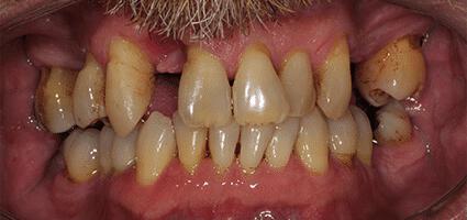 Crowns Full Upper