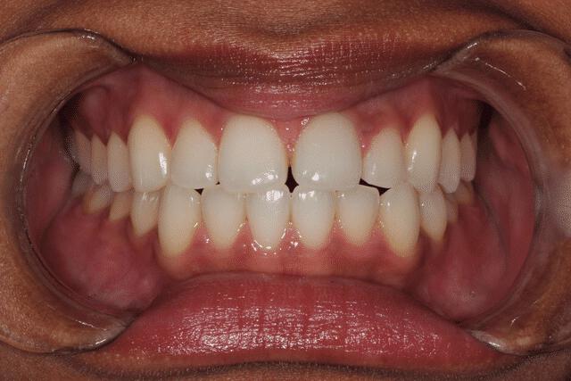 Upper Veneers