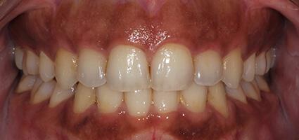 Full Mouth Reconstruction