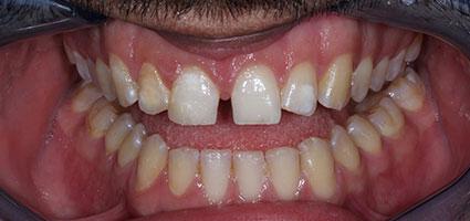Porcelain Veneers