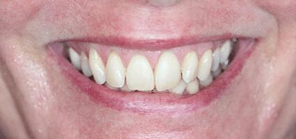 Laminate Veneers (upper)
