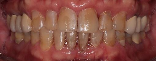 Porcelain Veneers and Dental Crowns