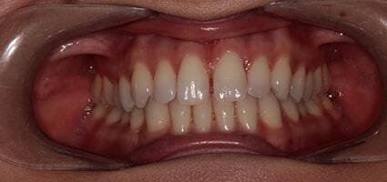 Porcelain Veneers