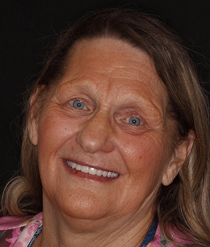 Dentures