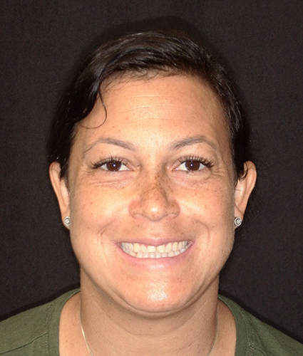 Implant dentistry and Facial Rejuvenation