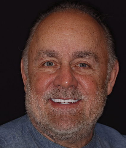 Implant dentistry and Facial Rejuvenation