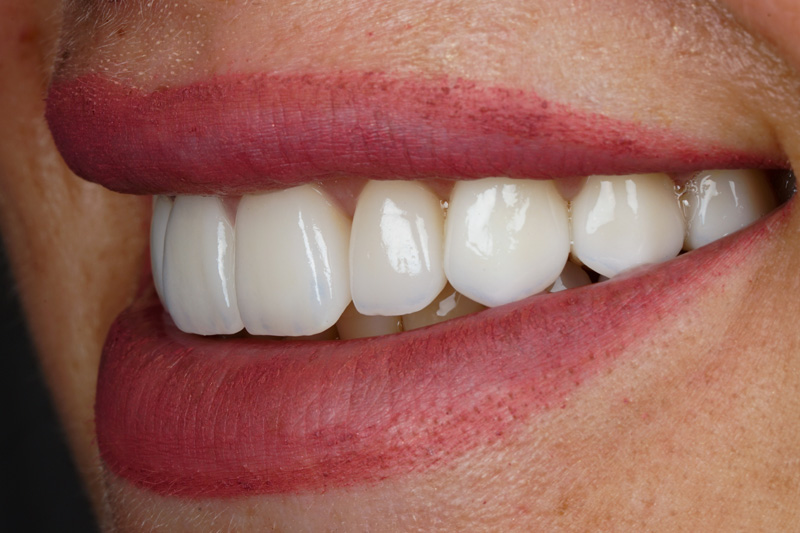Veneers