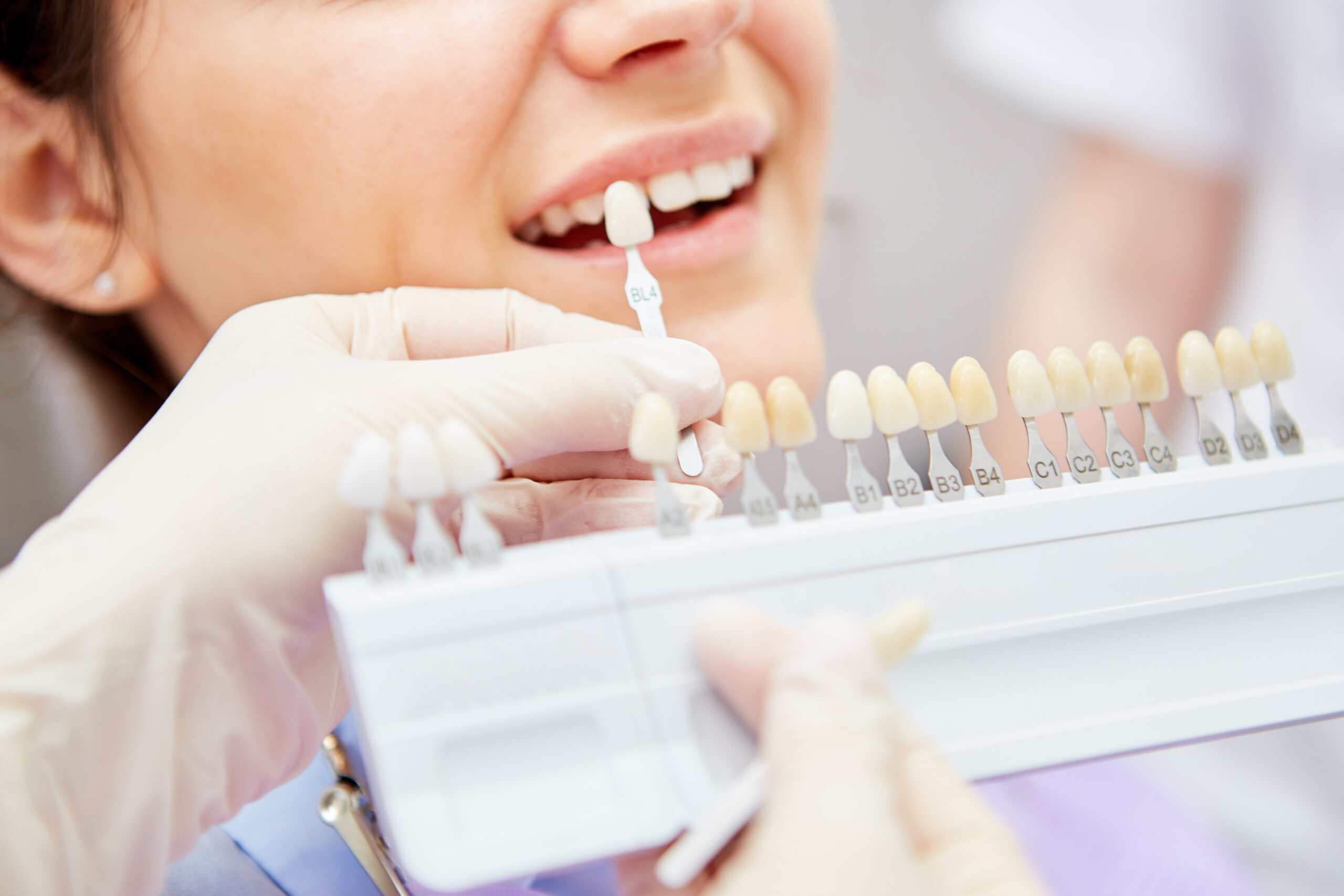 Selection of the correct tooth color for professional cosmetic bleaching at the dentist