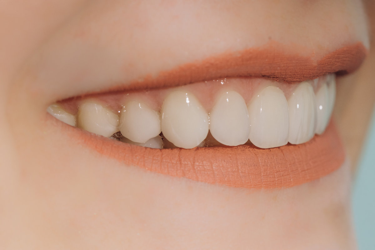 Finished ceramic front crowns. 8 units dental veneers.